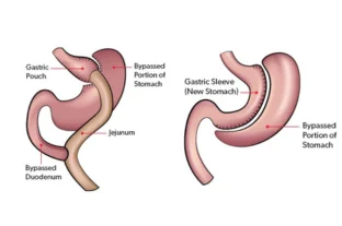 Types Of Bariatric Surgery