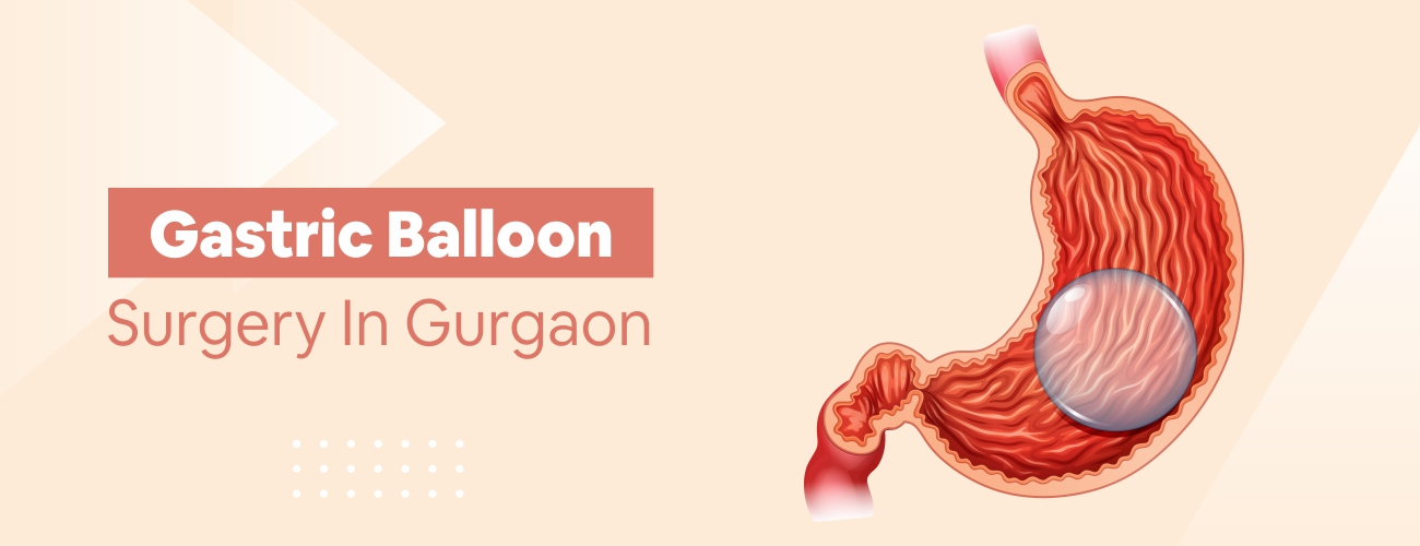 Advanced Gastric Balloon surgery in Gurgaon at affordable Cost