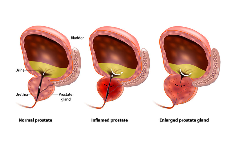 Enlarged Prostate (BPH) Treatment in Delh