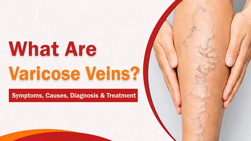 What Are Varicose Veins? Symptoms, Causes, Diagnosis & Treatment