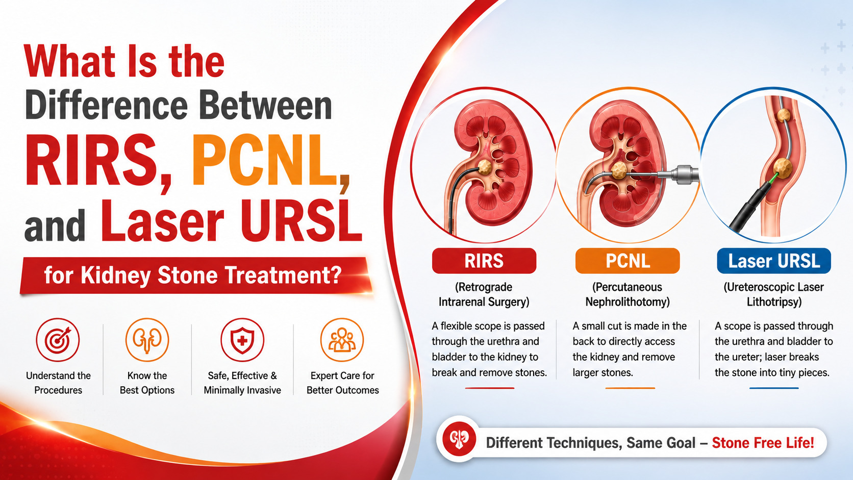 What Is the Difference Between RIRS, PCNL, and Laser URSL for Kidney Stone Treatment?